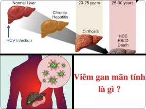 Viem gan man tinh la gi Nguyen nhan trieu chung va dieu tri