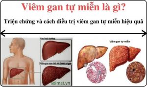 Viem gan tu mien la gi trieu chung va cac dieu tri benh hieu qua (2)