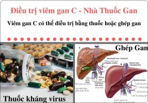 cac cach dieu tri viem gan c hieu qua
